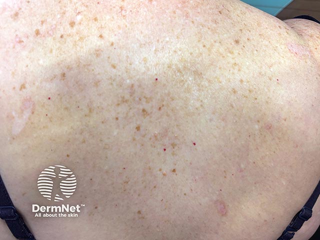 Plaques of lichen sclerosus on the back