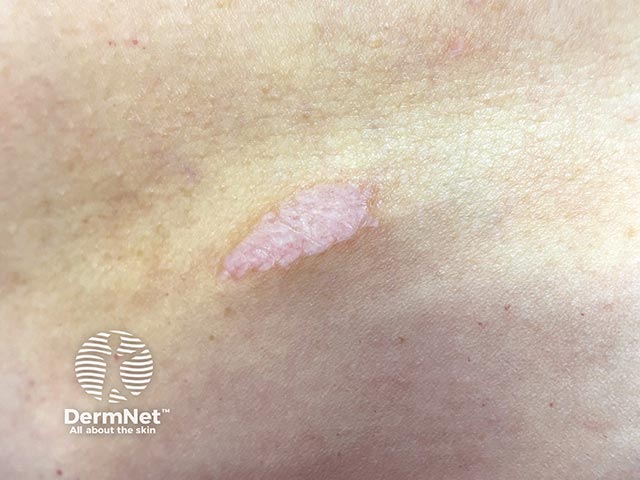 Close up of extragenital lichen sclerosus on the abdomen