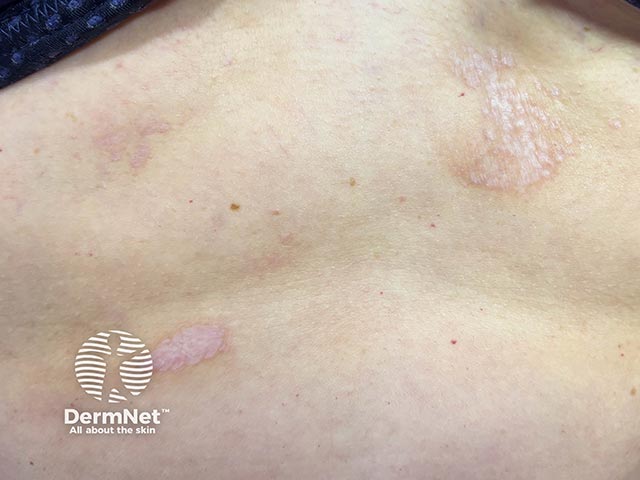 Lichen sclerosus plaques on the abdomen