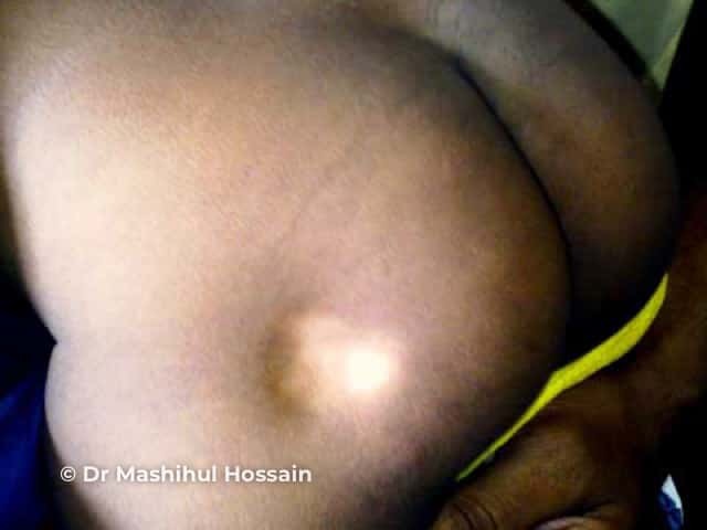 Lipodystrophy: acquired