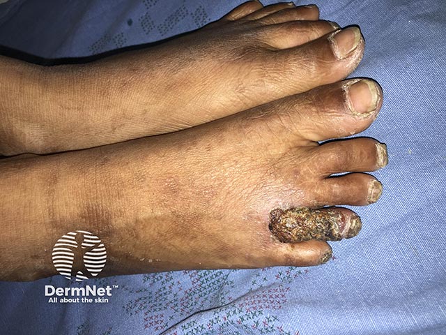 Crusted scaly lesions on the toe in lipoid proteinosis