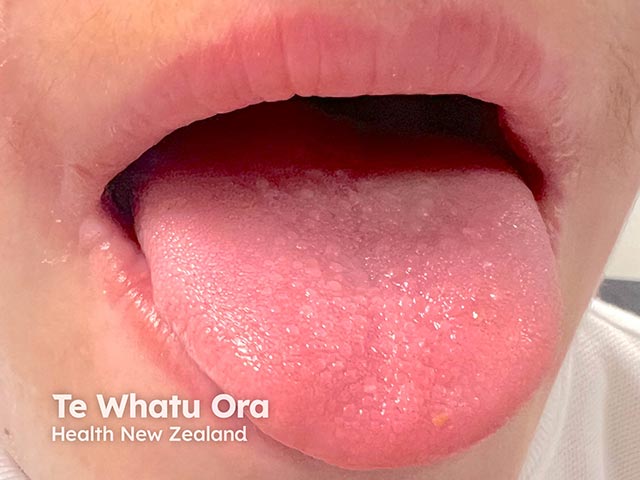 Papular lesions on the tongue