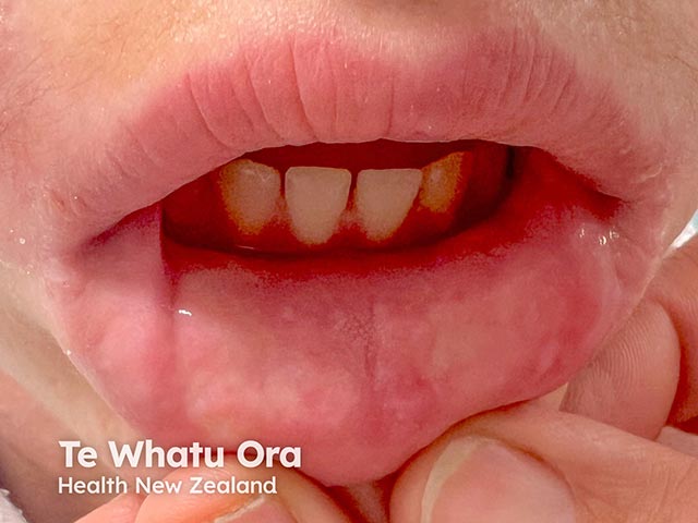 Lip papules and plaques