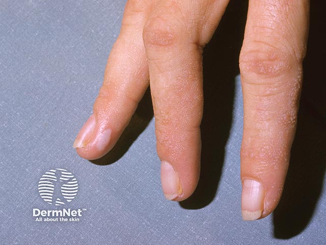Warty changes on the fingers in lipoid proteinosis