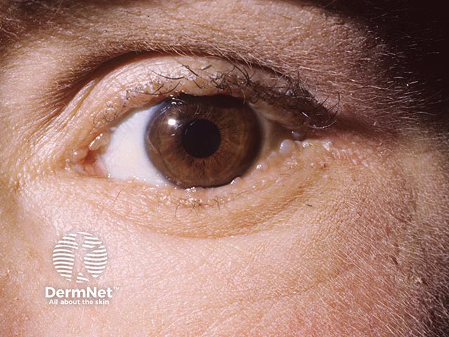 Characteristic pale eyelid papules