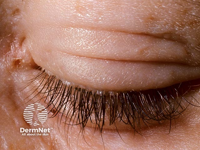 Eyelid papules in lipoid proteinosis
