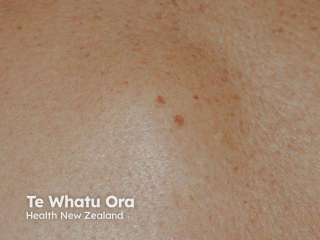 A lipoma on the back - it is more easily appreciated on palpation rather than on inspection