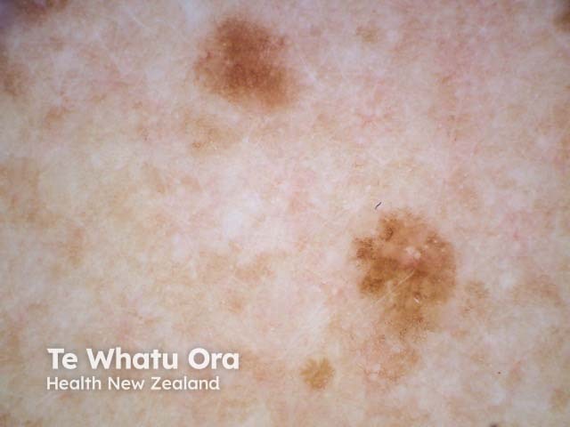 Dermoscopy of a lipoma. Note the relatively uniform appearance, lacking significant variation in colour or structures