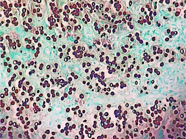 Grocot staining of lobomycosis showing oval yeast-like bodies