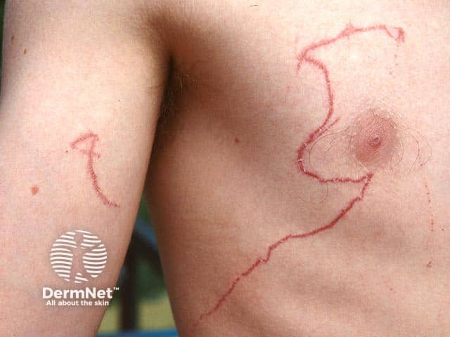 A serpentine configuration to box jellyfish stings