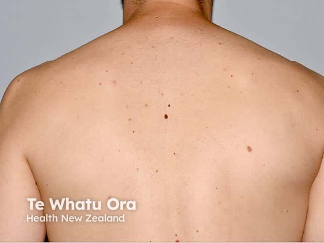 Two dark lesions on the mid-upper back - both in situ melanomas