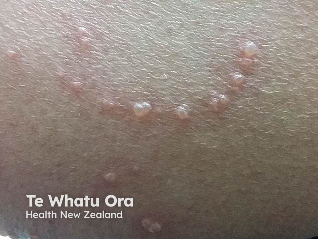 Pseudo-koebnerisation in a scratch