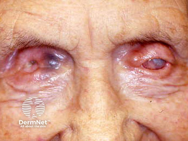 Severe scarring and symblepharon leading to blindness in mucous membrane pemphigoid