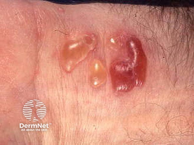 Cutaneous blisters in MMP - the mouth and eye were also affected
