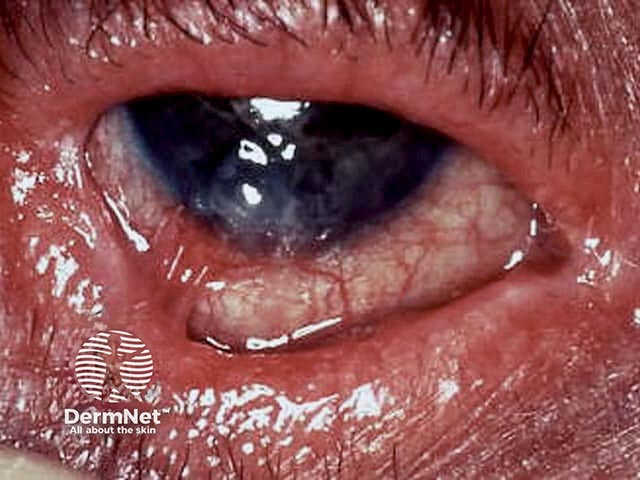 Scarring and inflammation of the conjunctiva in mucous membrane pemphigoid