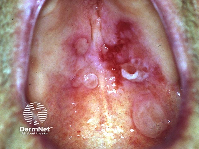 Oral blisters and erosions due to mucous membrane pemphigoid