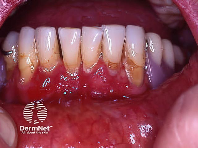 A desquamative gingivitis due to mucous membrane pemphigoid