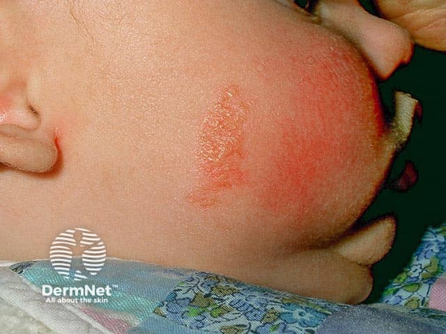 A naevus sebaceous on the right cheek in an infant - the orange-yellow colour is characteristic