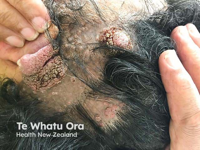 A naevus sebaceous in a 48 year old. Over the decades, the lesion has become warty and papillomatous