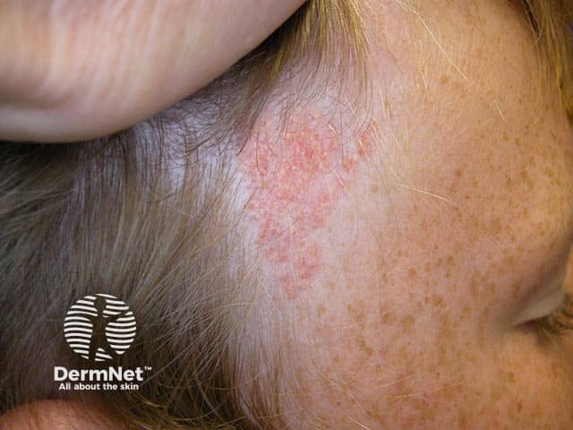 A naevus sebaceous on the anterior hair line - the orange-yellow colour is characteristic