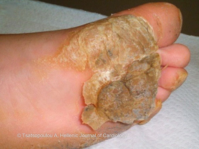 Marked hyperkeratosis over the forefoot in Naxos disease