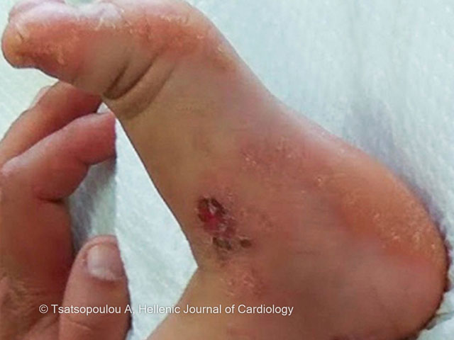 Plantar keratoderma in Naxos disease