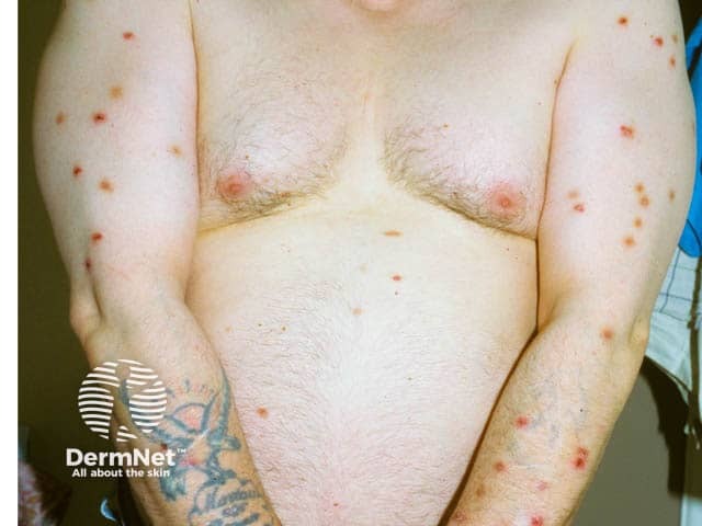 Prurigo may improve with standard dose naltrexone