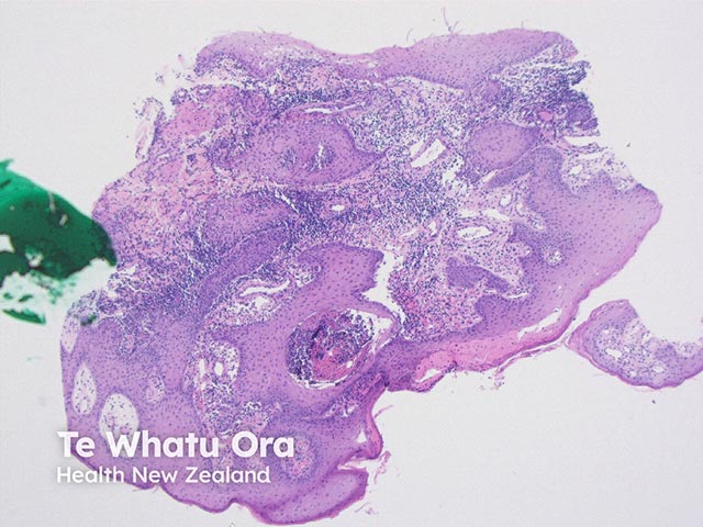 Low power view of a blastomycosis plaque - there is pseudoepitheliomatous epidermal hyperplasia and a dense dermal infiltrate