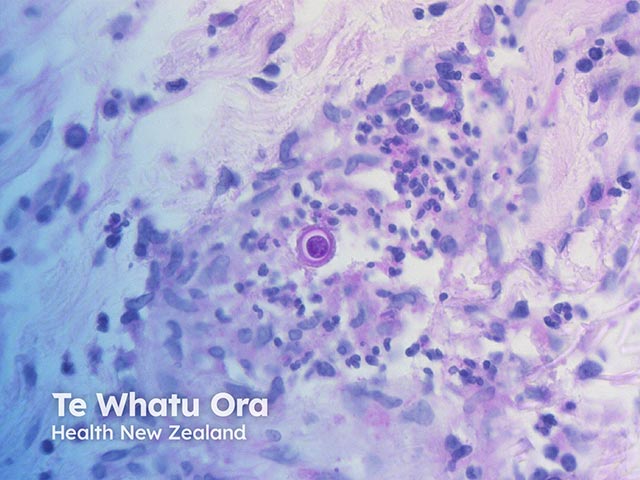 The double-walled Blastomyces dermatitidis organism seen on high power within the dermal infiltrate