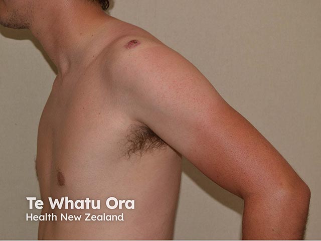 A haemorrhagic crusted plaque on the shoulder due to North American blastomycosis