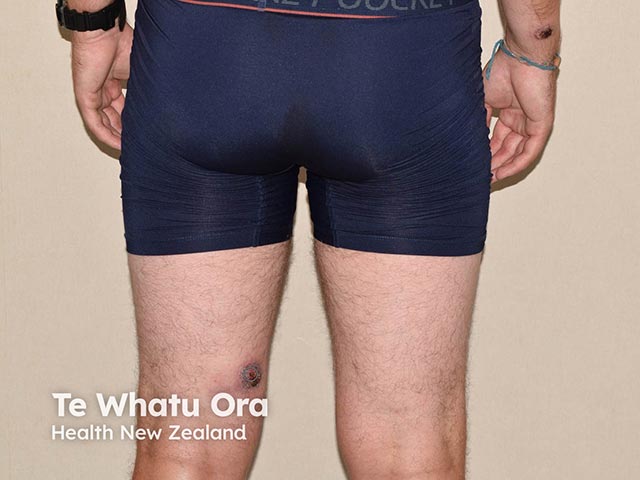 An ulcerated plaque on the thigh due to North American blastomycosis