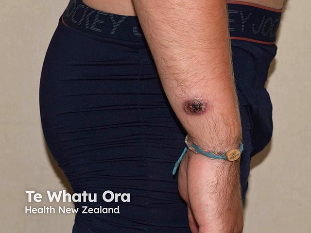 A haemorrhagic ulcerated plaque on the wrist due to North American blastomycosis