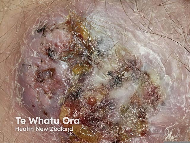 A raised, ulcerated, and oozing plaque due to North American blastomycosis