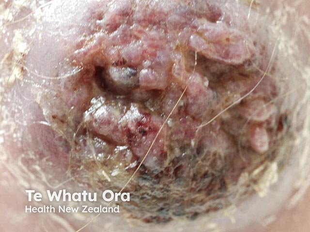 An ulcerated oozing and crusted plaque due to North American blastomycosis