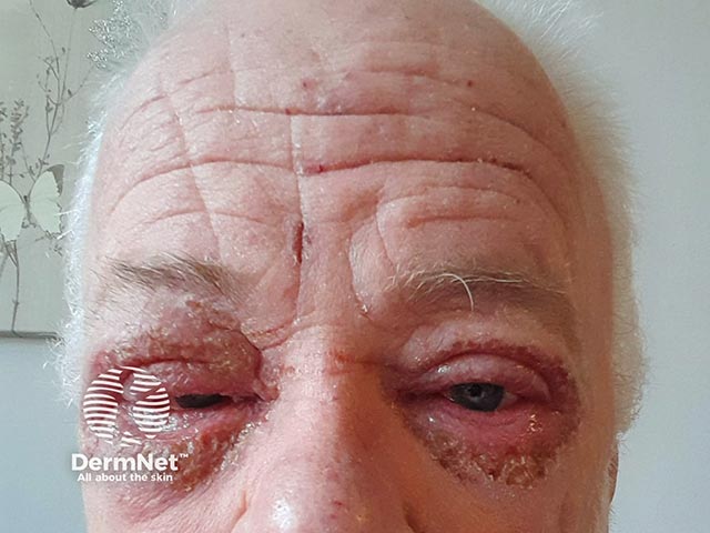 Dupilumab-induced ocular disease 8 weeks after treatment initiation