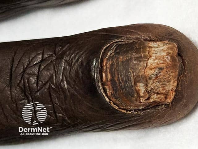 Total fingernail onychomycosis in type 6 skin