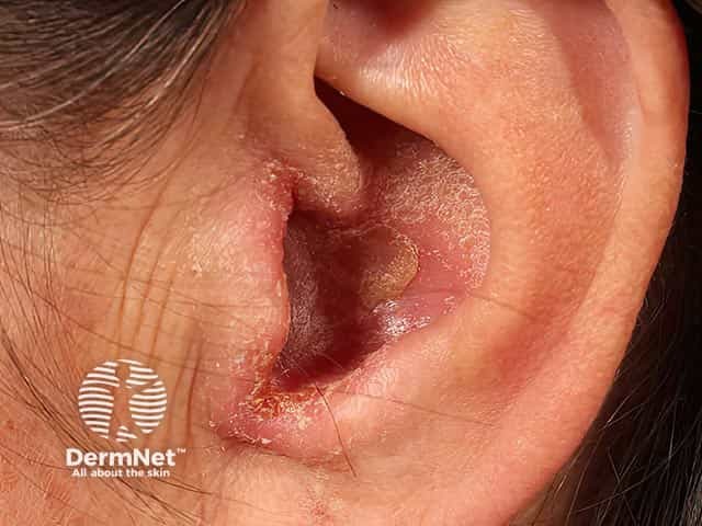 An eczematous otitis externa