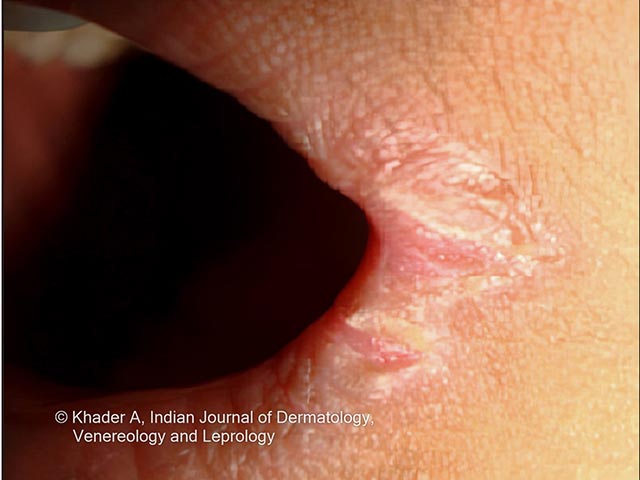 Angular cheilitis seen in PLACK syndrome