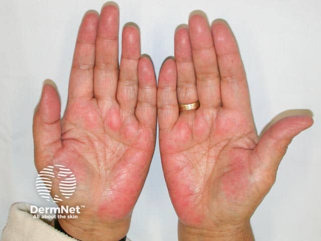 Subtle palmar erythema in mother