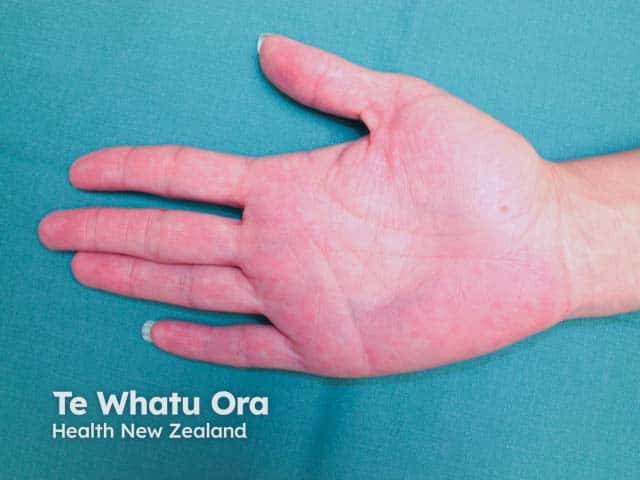 Palmar erythema