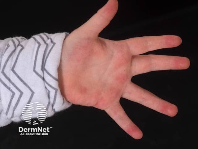 Palmar erythema in daughter