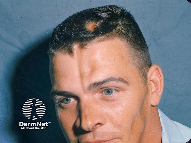 Linear morphoea with bone depression and an associated patch of scarring alopecia