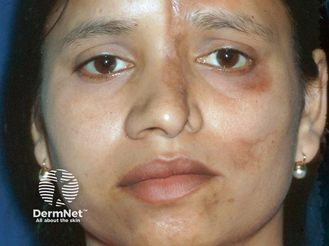 Dermal sclerosis is evident in morphoea, but there was also cerebral and lingual changes more in keeping with PRS