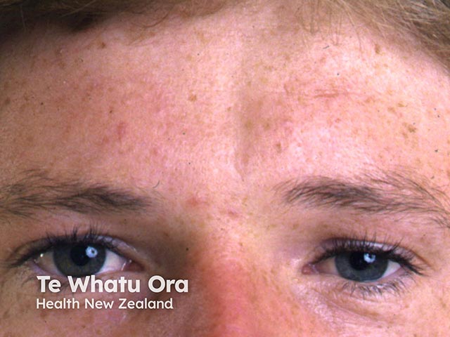 Linear morphoea with bony depression over the left medicla forehead