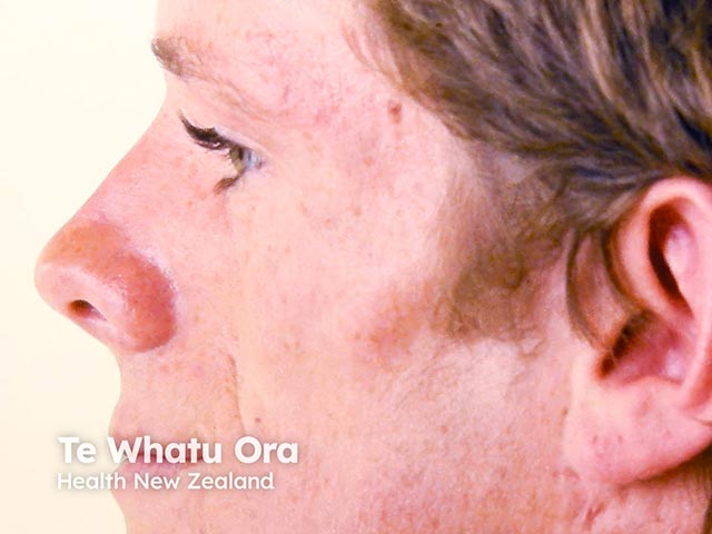 Hemifacial atrohpy with lifting of the commisure of the left lip