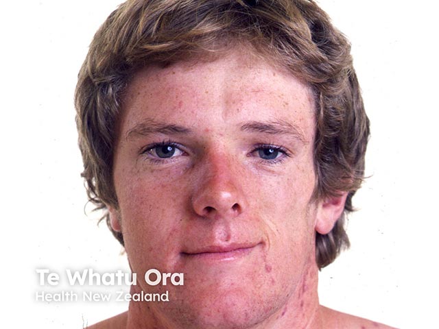 Hemiatrophy of the tongue in addition to facial changes of fat and muscle atrophy