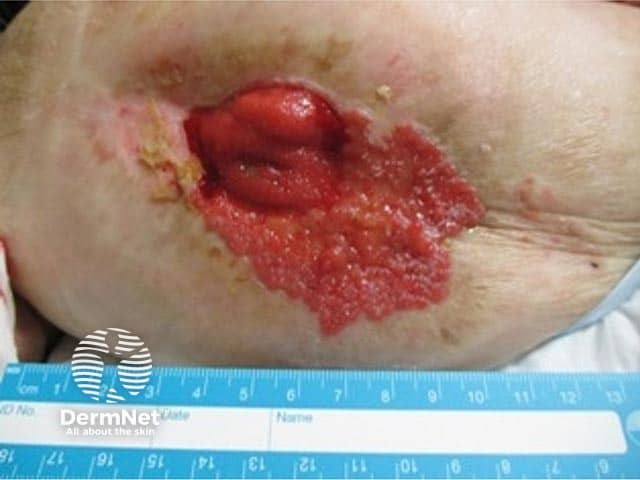 Well-defined granular eruption emanating from ileostomy site