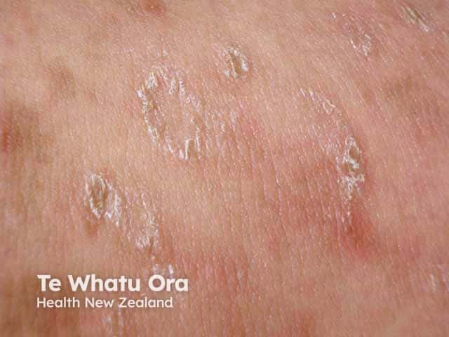 Mica-like scale in pityriasis lichenoides chronica