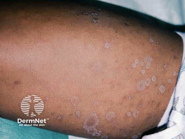 Pityriasis rosea showing annular scaly patches