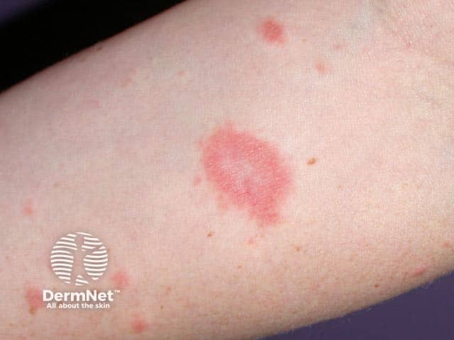 The herald patch of pityriasis rosea